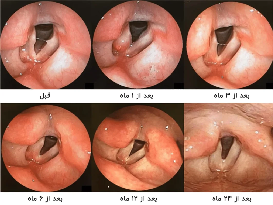 لارنگوسکوپی حنجره